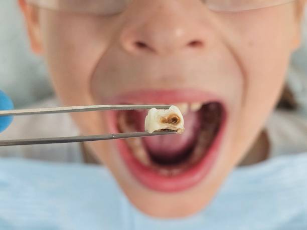 Best Emergency Gum Treatment in Montezuma, IA